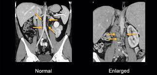 abdominal ct lymph nodes litfl