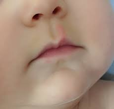 what is this mark above baby s lip