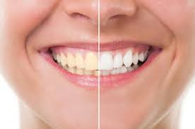 Dental bonding if chipping caused the gap between your teeth, dental bonding might be the best solution. How To Fix A Tooth Gap Without Braces Your Community Dental