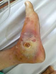 Image result for festering wound at feet