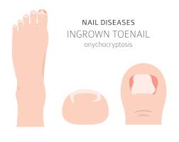 ingrown toenail remeore