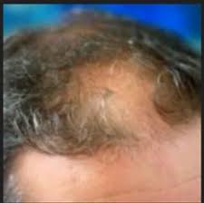 alopecia areata treatment services in