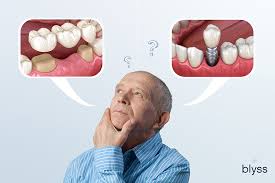 dental bridges vs dental implants 8