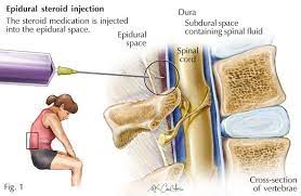 epidural steroid injection