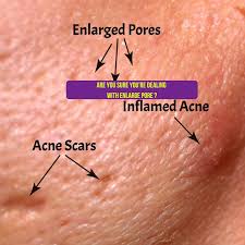 enlarged pores vs acne pitting scars