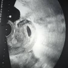 Ssw um die siebte schwangerschaftswoche herum nehmen die sog. Ultraschall Bild Ok Fur Die 7 Ssw 6 6 Gesundheit Und Medizin Schwangerschaft Schwanger