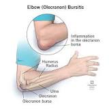Image result for icd 10 code for olecranon bursitis of left elbow