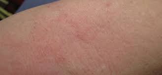 Ada beragam hal yang mungkin menyebabkan munculnya bintik merah pada kulit disertai gatal. Masalah Alergi Kulit Gatal Dan Membengkak Republika Online