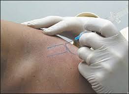 Steroid injections, or corticosteroids, can help treat a range of conditions, including arthritis. Diagnostic And Therapeutic Injection Of The Shoulder Region American Family Physician