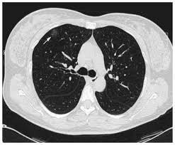 solitary pulmonary capillary hemangioma
