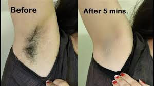 How to pop the blind pimples without getting it worse. How I Removed My Armpit Hair No Wax Shave Remove Underarms Hair At Home Youtube