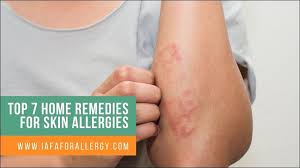 top 7 home remes for skin allergies