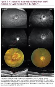 radiation retinopathy a review of past