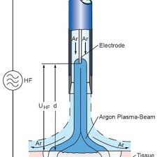pdf argon plasma coagulation