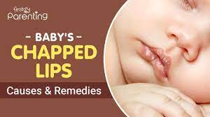 baby s chapped lips causes and remes