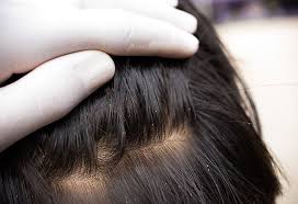 head lice in infants children