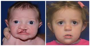 early cleft lip repair