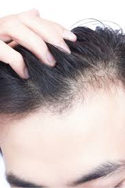 vitamin d deficiency hair loss