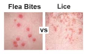 flea bites vs lice how do you tell