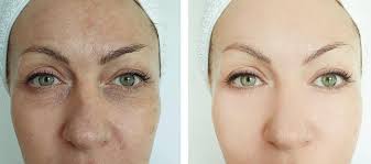 eyelid rejuvenation treatments