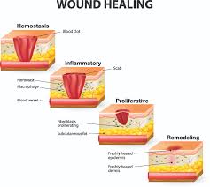 How Wounds Heal The 4 Main Phases Of Wound Healing Shield