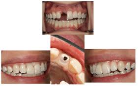 dental implants in kittanning
