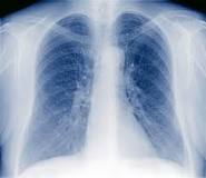 How a Chest X-ray Can Aid Asthma Patients | Independent Imaging