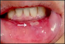 نتیجه تصویری برای زخم های دهان