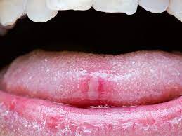 tongue cancer symptoms pictures and