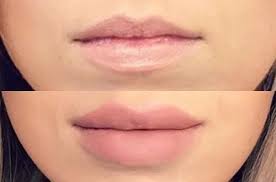 filler treatment for lip corrections at