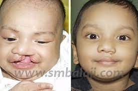 cleft lip and palate surgery india