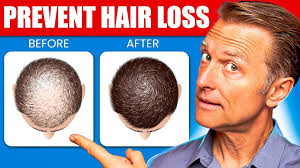 12 proven remes to prevent hair loss