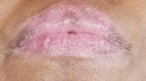 dry and inflamed lips