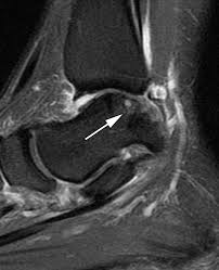 Varan a, unal s, ruacan s, vidinlisan s. Ct And Mr Imaging Of The Postoperative Ankle And Foot Radiographics