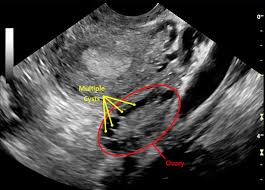 A pelvic ultrasound is a noninvasive diagnostic exam that produces images that are used to assess organs and structures within the female pelvis. The Pelvic Ultrasound Scan Fertility Test Conception Advice