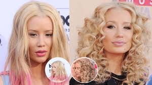 iggy azalea sparks more plastic surgery