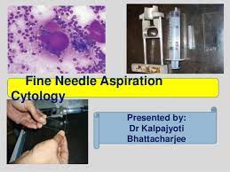 Fine needle aspiration biopsy (fnab) cytology of the thyroid gland,thyroid cytology. Fine Needle Aspiration Cytology Fnac