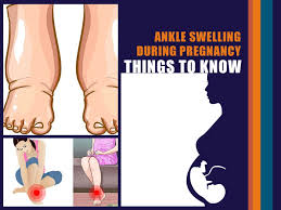 ankle swelling during pregnancy