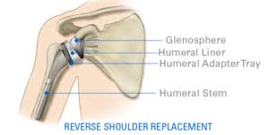 reverse total shoulder surgery outcomes