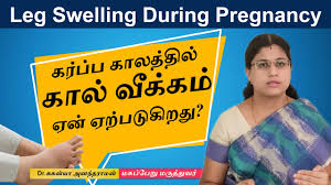edema leg swelling during pregnancy