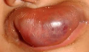 infantile hemangioma of the upper lip