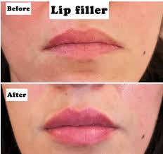 lip filler injections how long do they