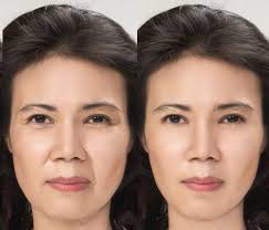 sunken face causes and treatments in