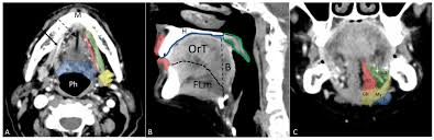 cavity computed tomography