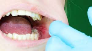Mundfäule (gingivostomatitis herpetica) ist eine durch herpesviren verursachte mundentzündung. Mundkrankheiten Diese Bilder Helfen Beim Erkennen