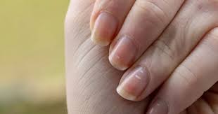 white spots appear on your nails