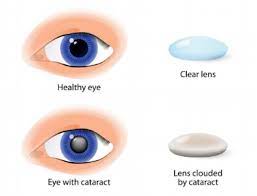 cataract ophthalmic consultants of