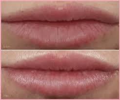 lip fillers on thin lips or for small