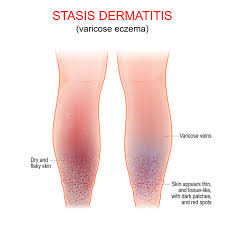 stasis dermais diagnosis and