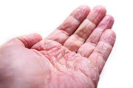 controlling hand eczema at home the